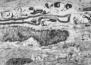 M, 2y. | globoid leukodystrophy (Krabbe disease) … n. suralis M, 2y. | globoid leukodystrophy (Krabbe disease) … n. suralis